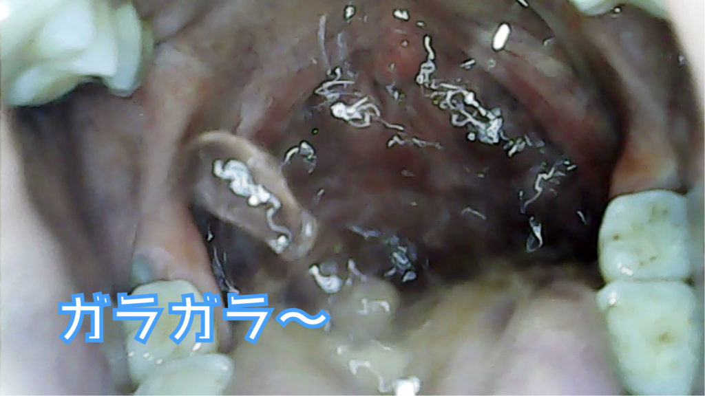 うがいで臭い玉がとれるのか 臭い玉除去 臭い玉をとる