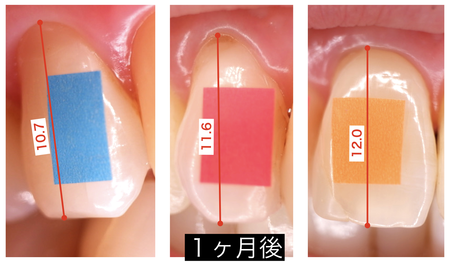 下がってしまった歯ぐきはジェットウォッシャーで戻るのか 002 臭い玉をとる
