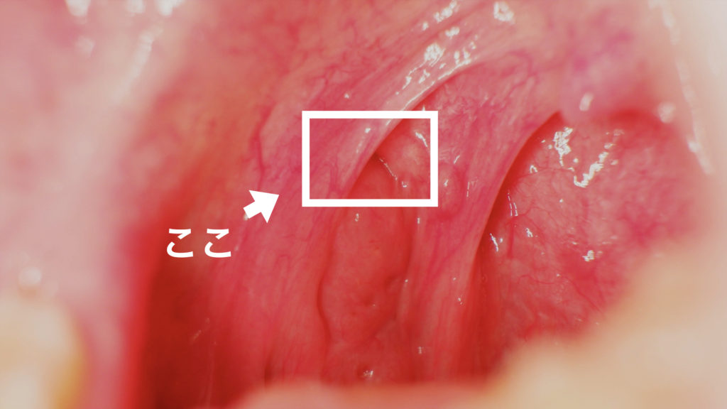 臭い玉はどこに隠れているんでしょう 膿栓場所 臭い玉をとる