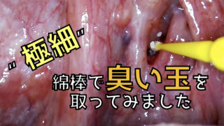 臭い玉をとる スッキリ除去して口臭をなくしましょう